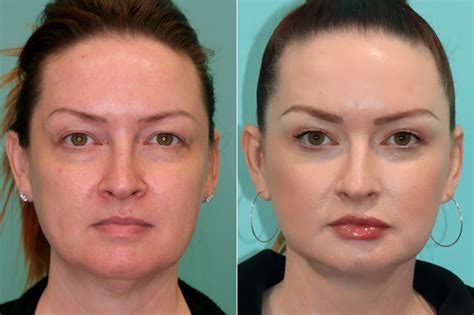 Discover the Life-Changing Benefits of Blepharoplasty Surgery: Find an Experienced Optometrist to Guide You